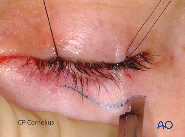 Subtarsal approach