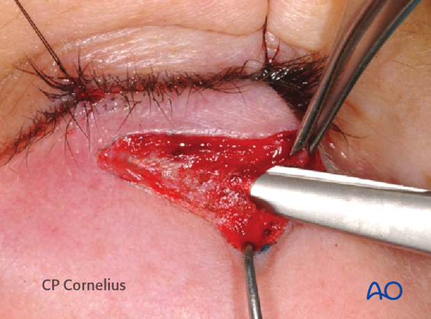 Subtarsal approach