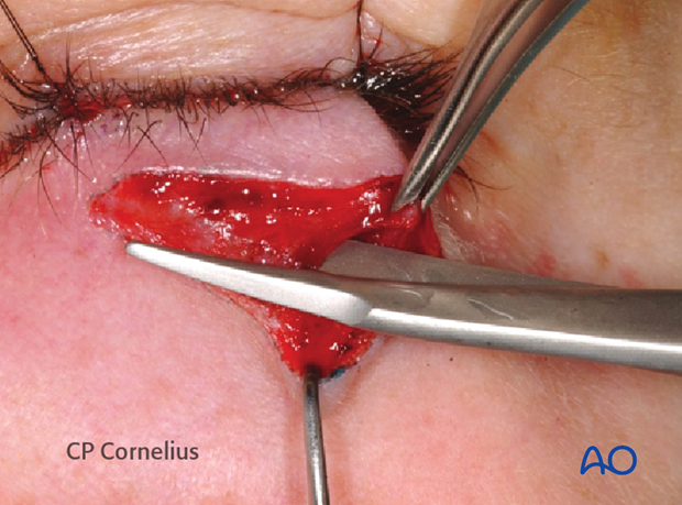 Subtarsal approach