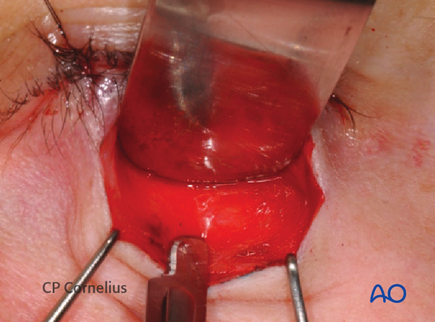 Subtarsal approach