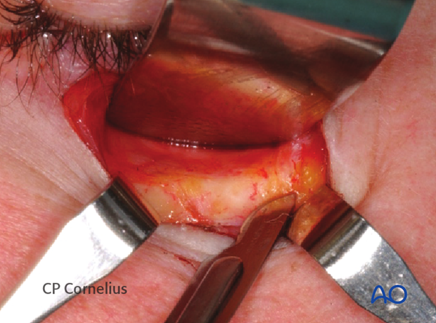 Subtarsal approach