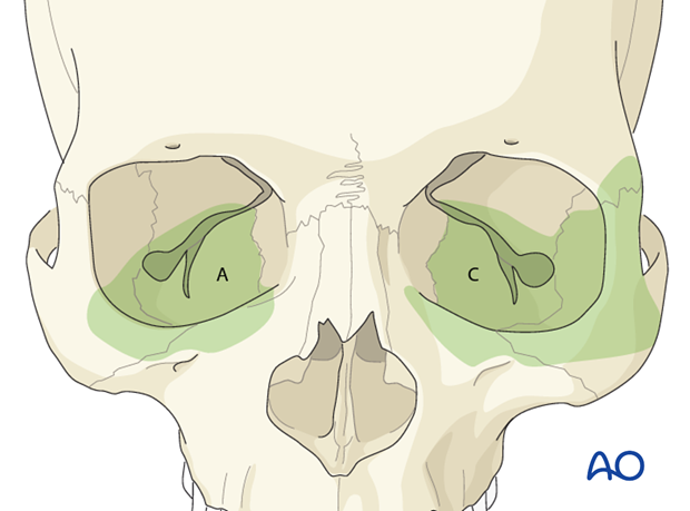 Transconjunctival lower-eyelid approaches