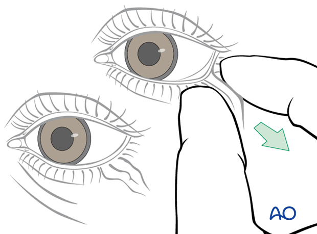 Transconjunctival lower-eyelid approaches