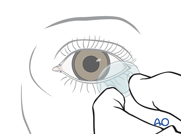 Transconjunctival lower-eyelid approaches