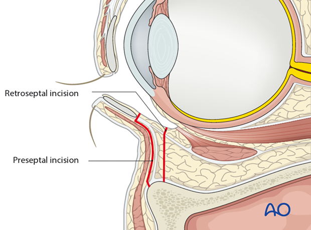 Inferior fornix transconjunctival 