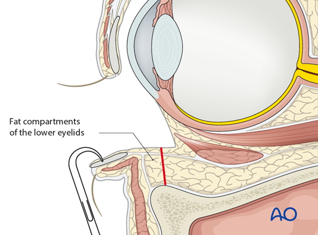 Inferior fornix transconjunctival 