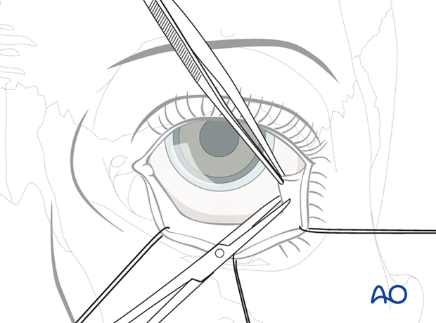 Inferior fornix transconjunctival 