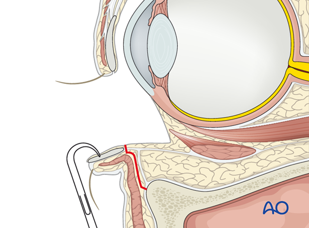 Inferior fornix transconjunctival 