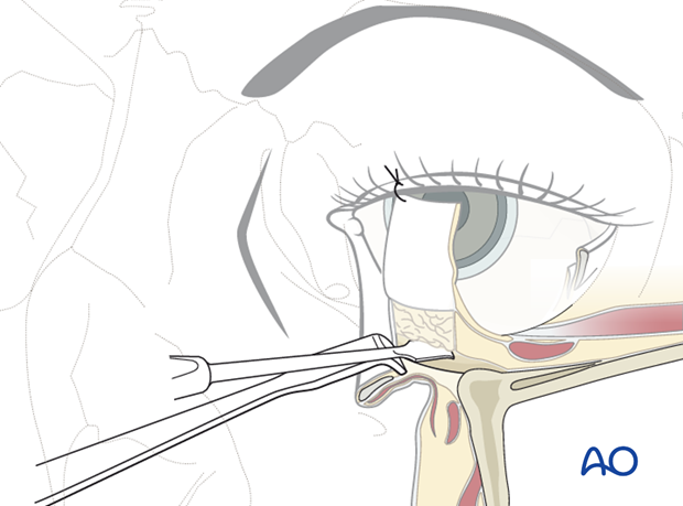 Inferior fornix transconjunctival 