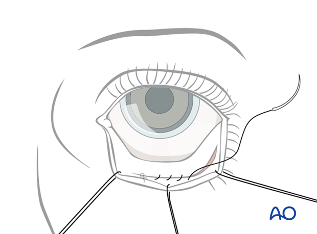 Inferior fornix transconjunctival 