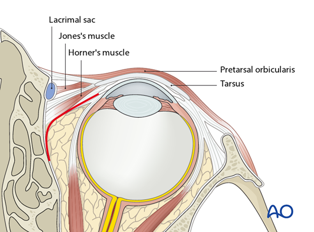 Pre-/Transcaruncular approach