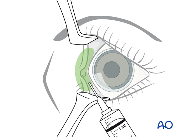 Pre-/Transcaruncular approach