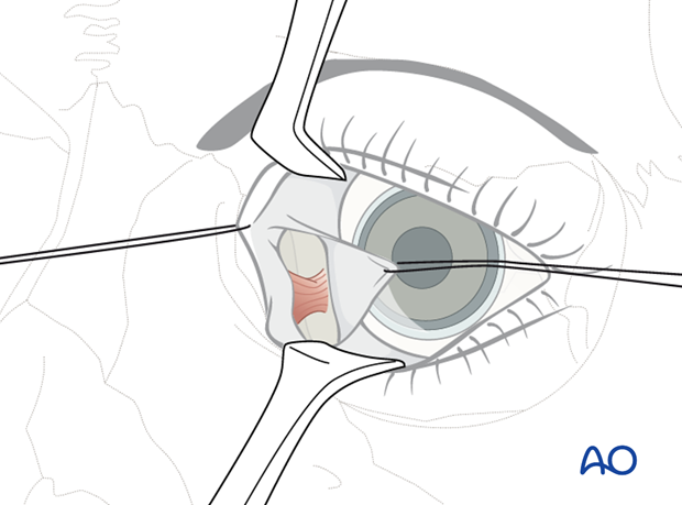 Pre-/Transcaruncular approach