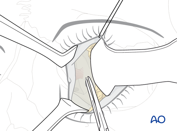 Pre-/Transcaruncular approach