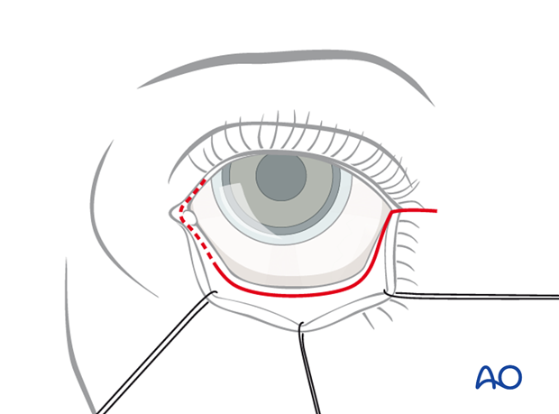 Transconjunctival approach with lateral skin extension