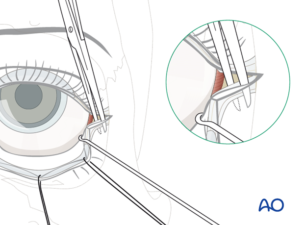 Transconjunctival approach with lateral skin extension