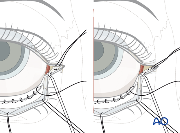 Transconjunctival approach with lateral skin extension