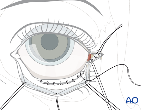 Transconjunctival approach with lateral skin extension