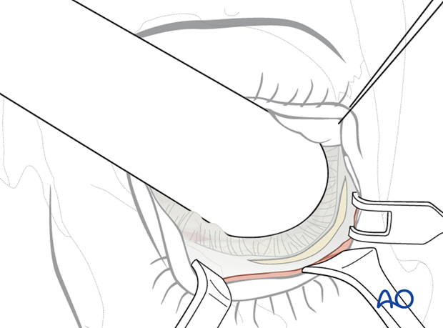 Transconjunctival approach with lateral skin extension