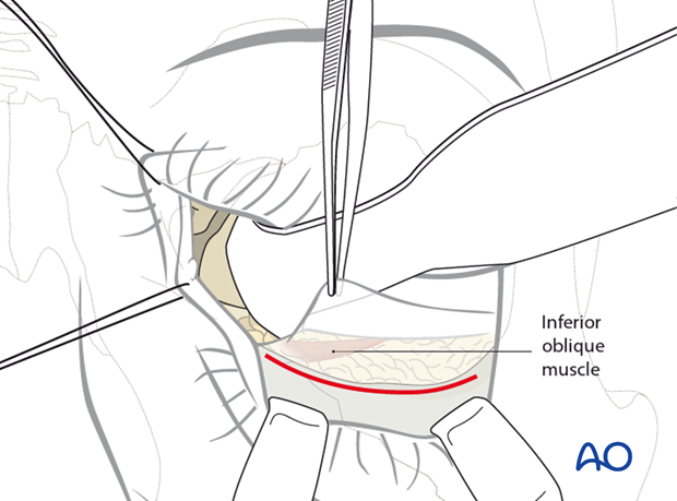 Combination of inferior and medial transconjunctival