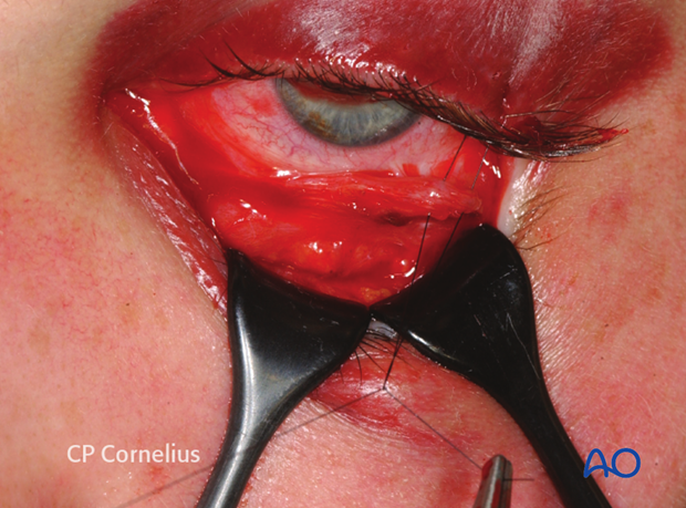 Transconjunctival lower-eyelid approaches