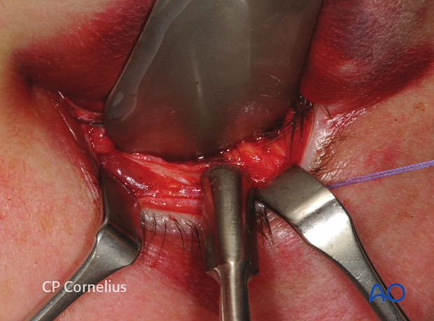 Inferior fornix transconjunctival 