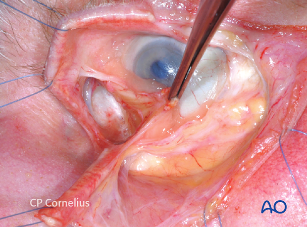 Pre-/Transcaruncular approach