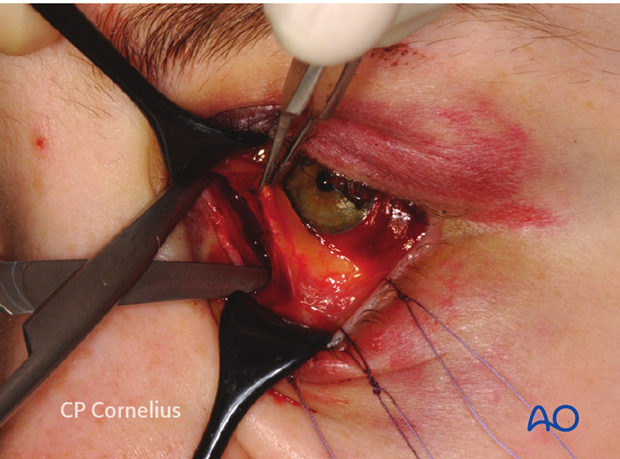 Pre-/Transcaruncular approach