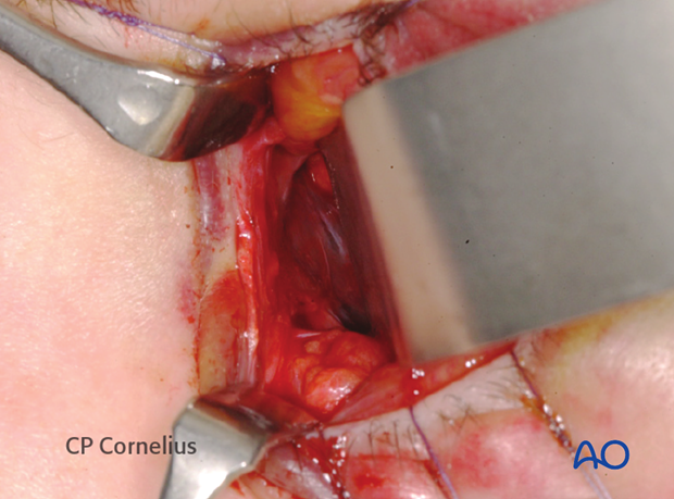 Pre-/Transcaruncular approach