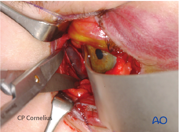 Pre-/Transcaruncular approach