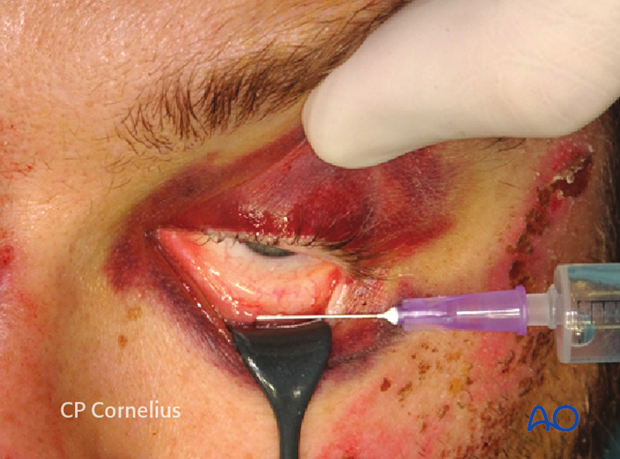 Transconjunctival approach with lateral skin extension