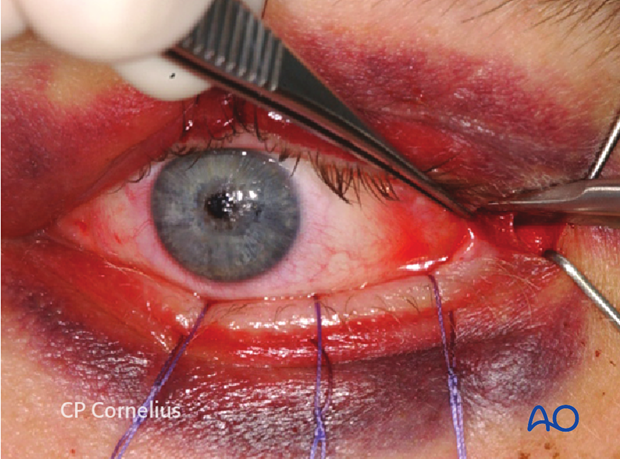 Transconjunctival approach with lateral skin extension