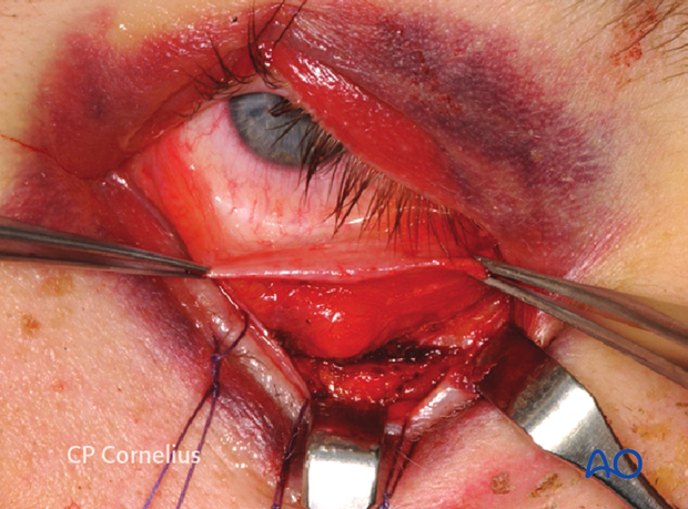 Transconjunctival approach with lateral skin extension