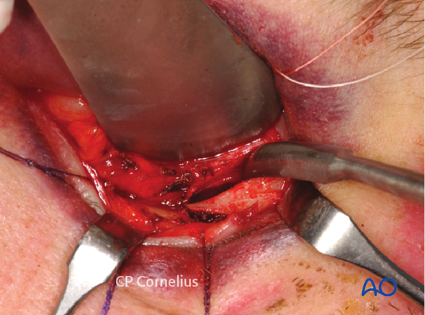 Transconjunctival approach with lateral skin extension