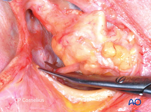 Combination of inferior and medial transconjunctival