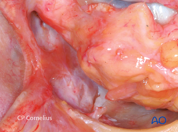 Combination of inferior and medial transconjunctival