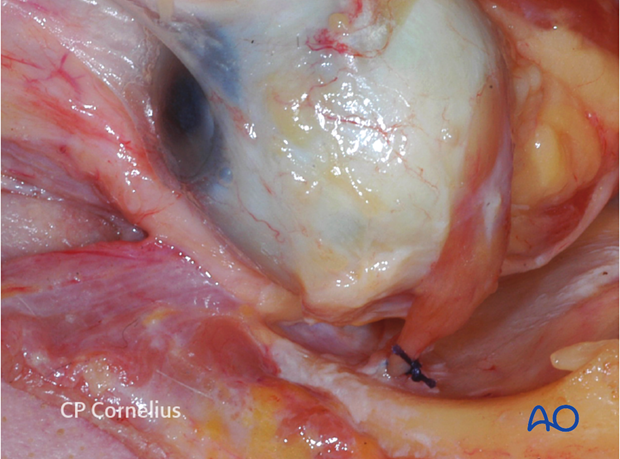 Combination of inferior and medial transconjunctival