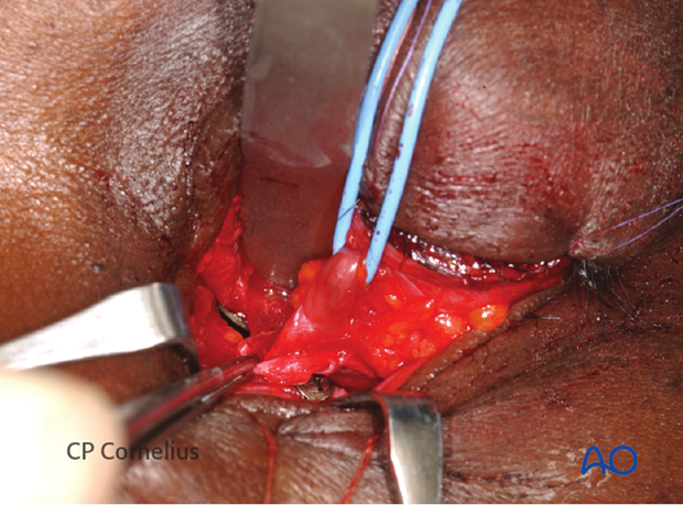 Combination of inferior and medial transconjunctival