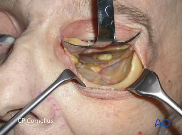 C-shaped incision