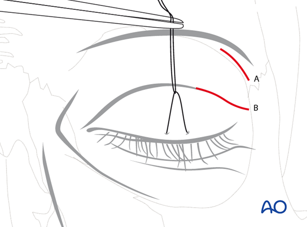 Approaches to the superolateral orbital rim