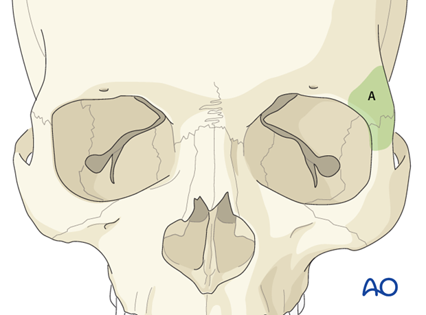 Approaches to the superolateral orbital rim