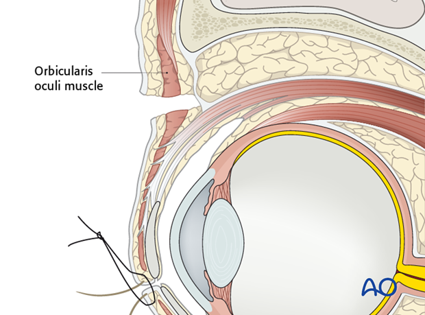 Extended glabellar approach