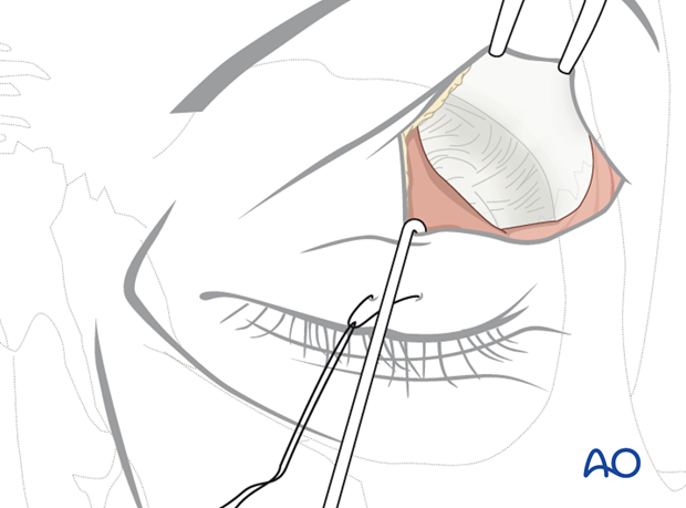 Upper-eyelid approach