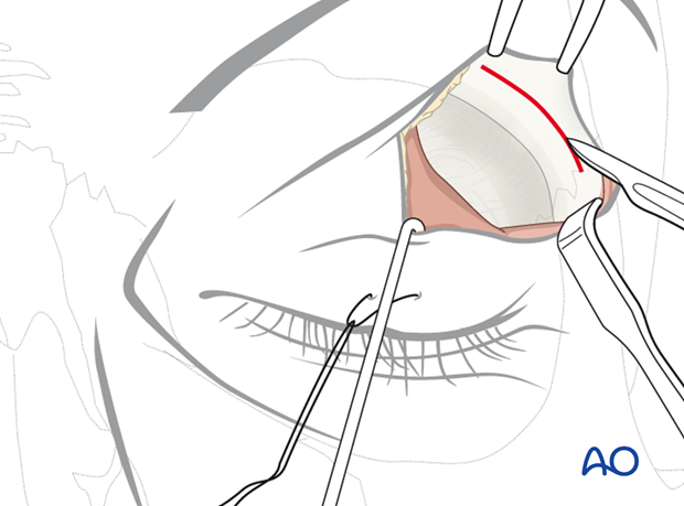 Upper-eyelid approach