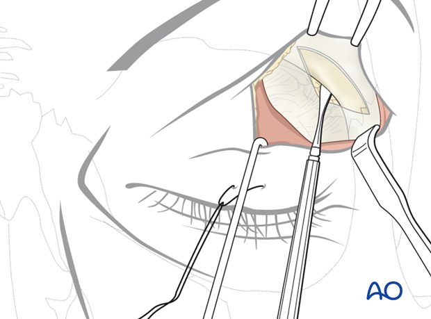 Upper-eyelid approach