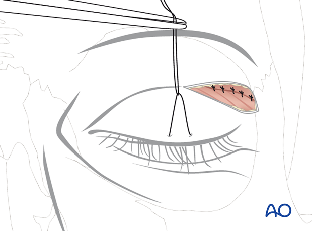 Upper-eyelid approach