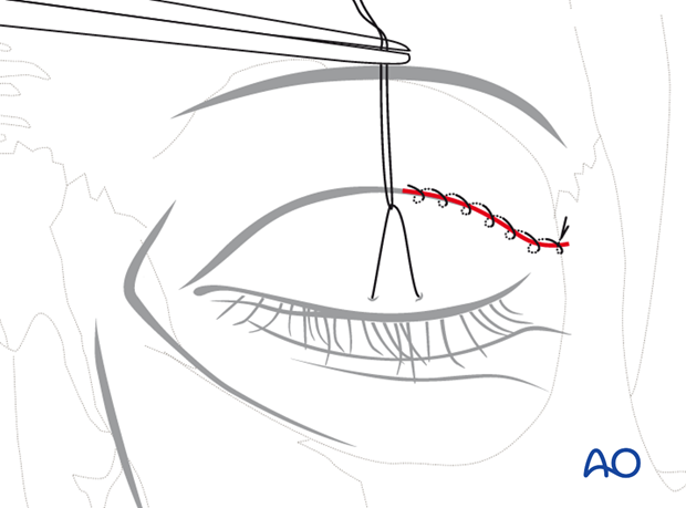 Upper-eyelid approach