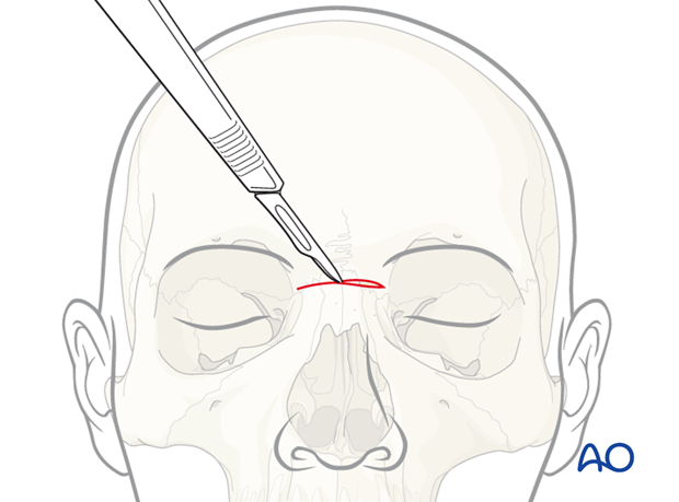 Skin incision