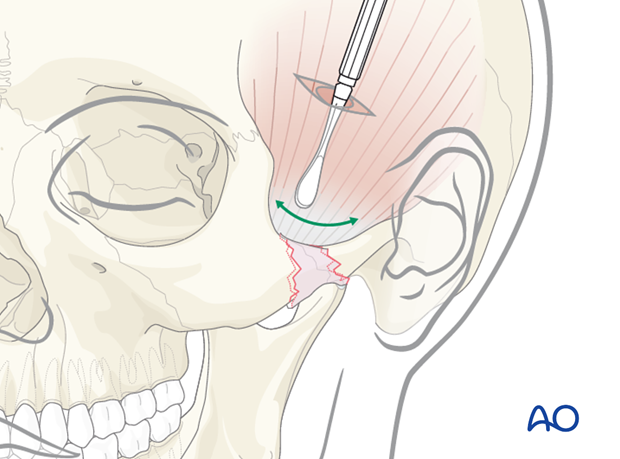 Indirect approaches to the zygomatic arch