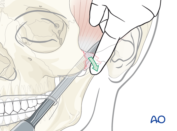 Indirect approaches to the zygomatic arch